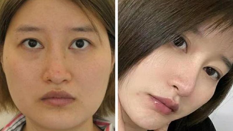 玻尿酸原料批发价格波动：揭秘背后的行业真相**