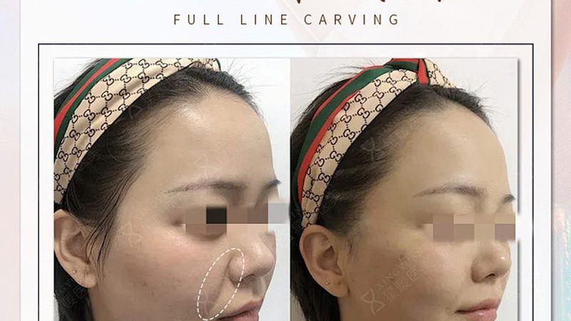玻尿酸：填充与保湿的天然选择