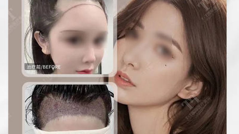 广州光子嫩肤与超光子：揭秘团购价格背后的差异