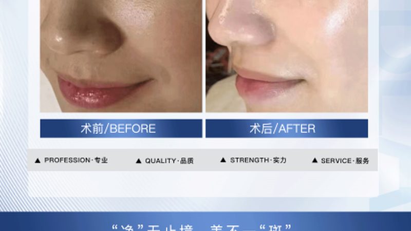 瘦脸绷带：揭秘其价格构成与选择要点