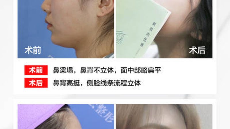 蛋白线提升术后，这些注意事项你了解吗？**