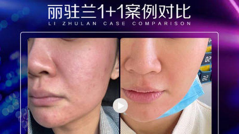 功率：光子嫩肤仪的核心参数