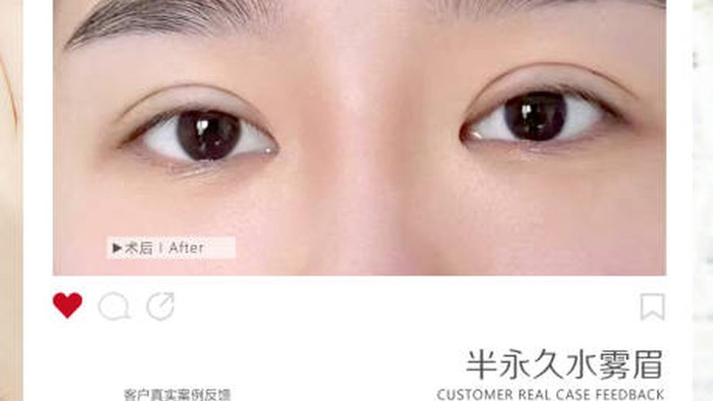 超声炮术后多久可二次治疗？揭秘恢复周期与注意事项