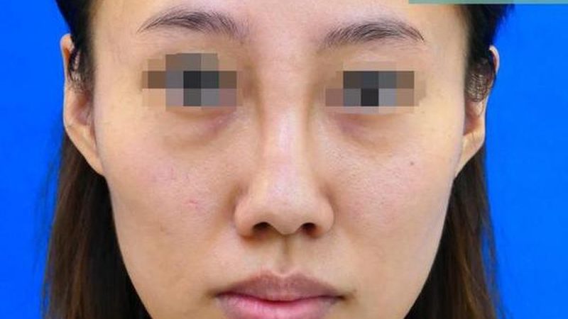 西安磨骨手术：揭秘价格背后的考量因素**